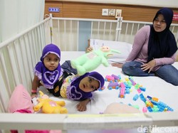RSHS Segera Operasi Kaki Tambahan Balita Kembar Siam Asal Garut