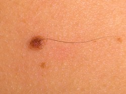 6 Cara Menghilangkan Tahi Lalat Secara Alami, Bisa Dicoba!