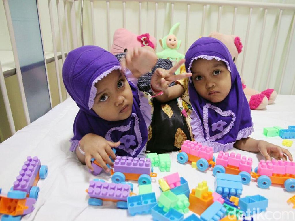Putri dan Dewi, Bocah Kembar Siam Asal Garut Cerdas dan Periang