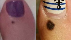 Contoh Foto-foto Tahi Lalat yang Patut Dicurigai Kanker Kulit