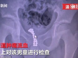 Bocah Ini Dioperasi untuk Keluarkan 26 Butir Bola Magnet dari Mr P