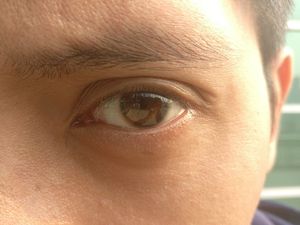 Ouch, Sudut Mata Pria Ini Tertusuk Kawat