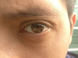 Ouch, Sudut Mata Pria Ini Tertusuk Kawat