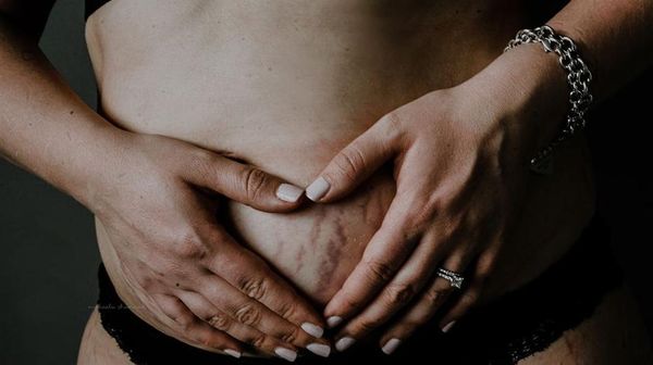 Foto: Garis dan Lipatan Cinta di Perut Ibu