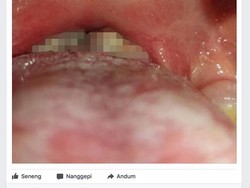 Seram! Seperti Ini Risikonya Jika Melewatkan Vaksin Difteri