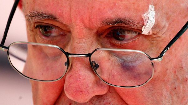 Begini Wajah Lebam Paus Fransiskus Usai Terbentur Mobil