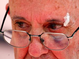 Begini Wajah Lebam Paus Fransiskus Usai Terbentur Mobil