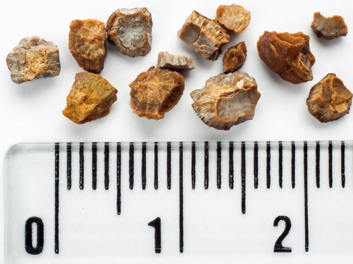 Batu ginjal Kidney stones after ESWL intervention. Lithotripsy. Scale in centimeters