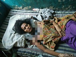 Polsek Rancaekek Antar Warga Miskin Kulit Melepuh ke RSHS