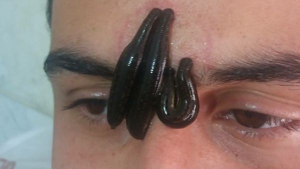 Potret Terapi Lintah, Berani Seperti Mereka?