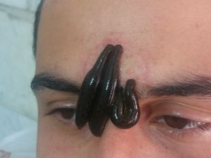 Potret Terapi Lintah, Berani Seperti Mereka?