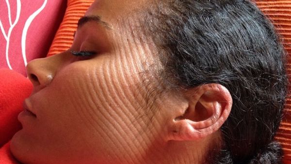 Tidur Lelap, Orang-orang Ini Bangun dengan Pola Lucu di Kulitnya
