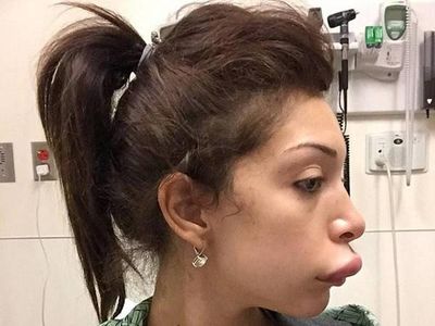 Foto: Wanita-wanita yang Gagal Filler Bibir Jadi Jontor Hingga Miring
