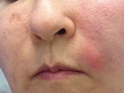 Coba Facial Vampir, Wajah Wanita Ini Malah Bengkak Kena Infeksi