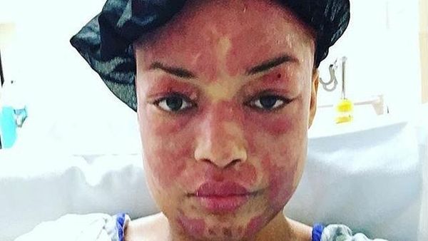 Foto-foto Ini Gambarkan Proses Penyembuhan Pasca Operasi Lupus