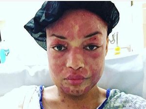 Foto-foto Ini Gambarkan Proses Penyembuhan Pasca Operasi Lupus