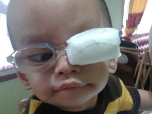 Bayangan Awan di Mata Bayiku Itu Ternyata Tanda Katarak