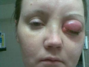 Cerita Wanita Berjuang 10 Tahun Melawan Parasit di Mata karena Softlens