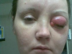 Cerita Wanita Berjuang 10 Tahun Melawan Parasit di Mata karena Softlens