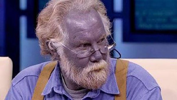 5 Penyakit Langka yang Sering Disangka Kena Guna-Guna