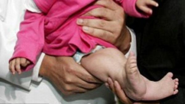 Potret Anak-Anak yang Terlahir sebagai Putri Duyung