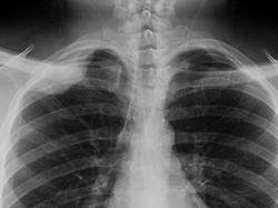 Dokter di Australia Terlalu Banyak Lakukan Rontgen