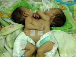 RSHS Rawat Bayi Kembar Siam Dempet Perut dan Dada Asal Bandung