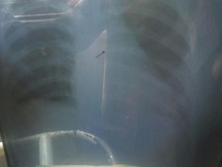 Jarum Pentul Tertelan Anisa, Dinkes Sumedang Turun Tangan