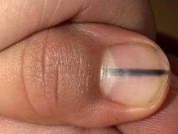 Dikira Darah Beku, Garis Hitam pada Kuku Ini Ternyata Kanker