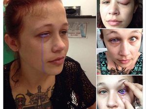 Seram! Gara-gara Tato Mata, Gadis Ini Hampir Kehilangan Penglihatannya