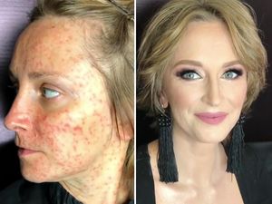 Jerawatan Satu Wajah, Muka Wanita Ini Seketika Jadi Mulus Berkat Makeup