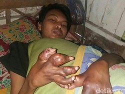 Menderita Asam Urat Akut, Tangan Nusron Berubah jadi Begini