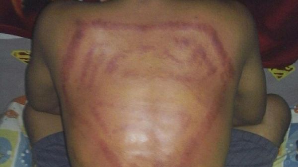 Bekas-bekas Kerokan Anti Mainstream: Lukis Wajah, Sampai Nyatakan Cinta