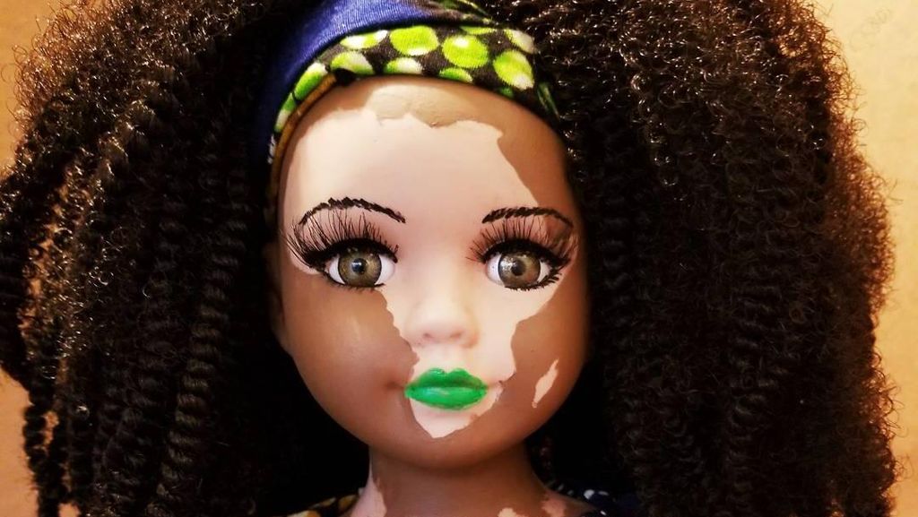 Barbie Berwarna Belang Dibuat Seniman Ini untuk Hargai Vitiligo