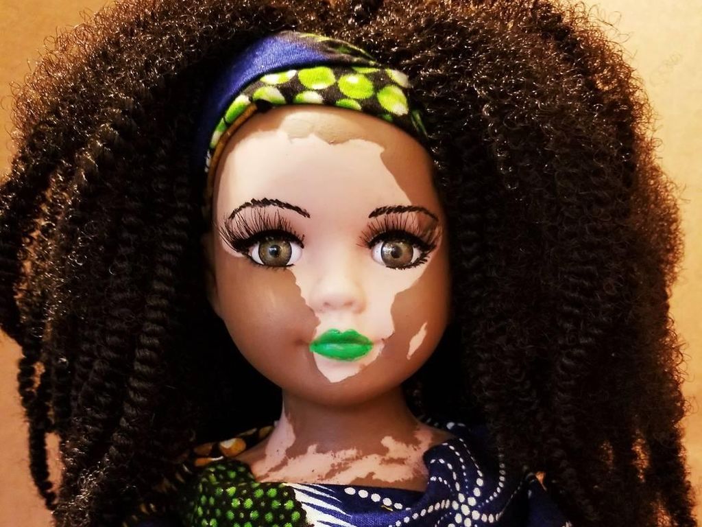 Barbie Berwarna Belang Dibuat Seniman Ini untuk Hargai Vitiligo