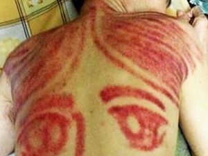 Pengobatan Alternatif Terpopuler Ini Ternyata Cuma Mitos