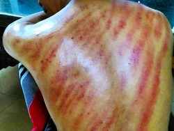 Semakin Merah Hasil Kerokan Bukan Berarti Makin Bagus, Ini Alasannya