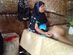 Derita Suhati, Penderita Kanker Tulang di Rumah Gubuk Aceh Utara