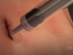 Peneliti Australia Kembangkan Lem Super Untuk Obati Luka Manusia