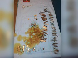 Dokter Angkat 100 Potong Besi dari Perut Pria Pengidap Psikosis