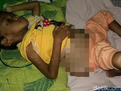 Bocah Sukabumi yang Diduga Salah Obat Ternyata Tumor dan Gizi Buruk