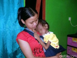 Bocah Asal Sukabumi Ini Ditumbuhi Benjolan di Punggungnya