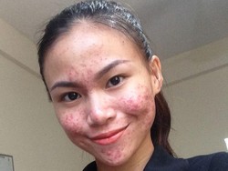 Bangga Pamer Foto Penuh Jerawat, Wanita Ini Ubah Persepsi tentang Cantik