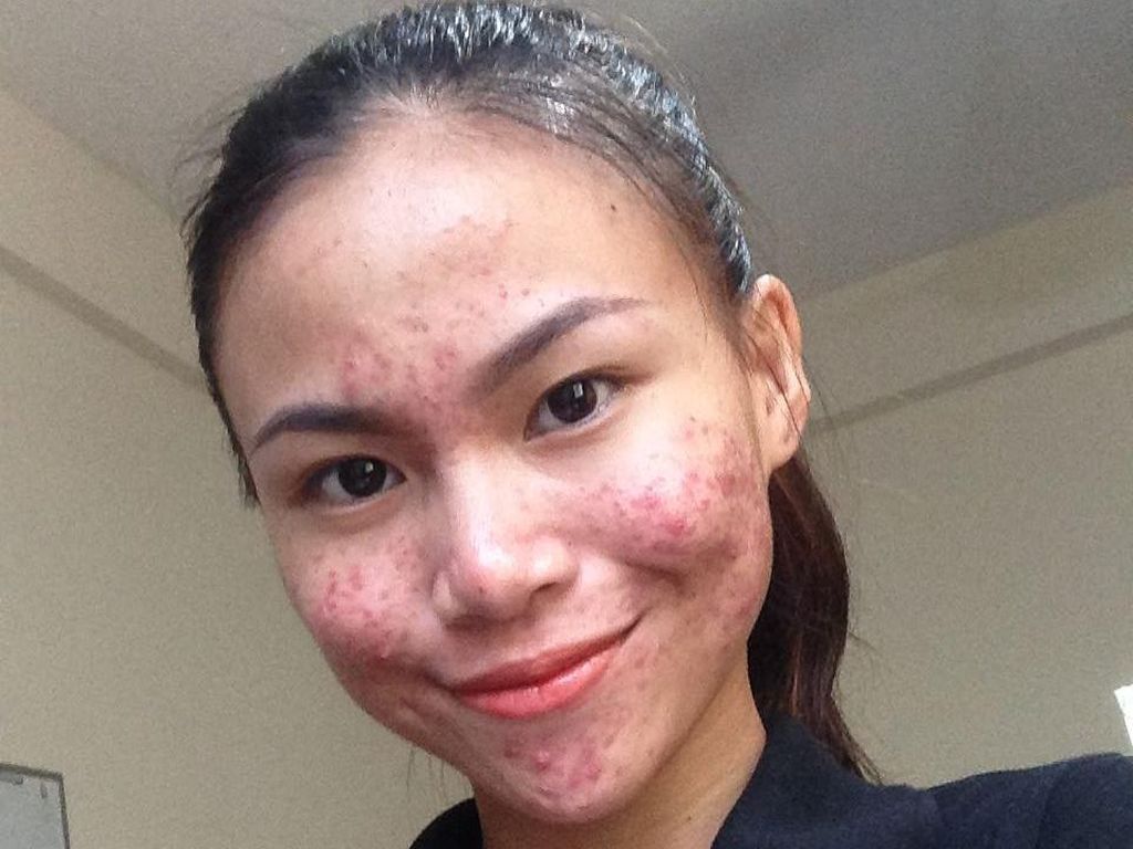 Bangga Pamer Foto Penuh Jerawat, Wanita Ini Ubah Persepsi tentang Cantik Bangga Pamer Foto Penuh Jerawat, Wanita Ini Ubah Persepsi tentang Cantik