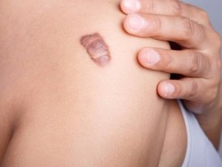 Begini Cara Cepat Sembuhkan Bekas Luka pada Kulit