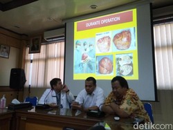 Tim Dokter RSUD dr Moewardi Solo Angkat Tumor Ganas Tanpa Amputasi