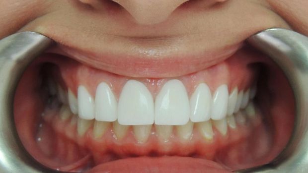 Ilustrasi sakit gigi