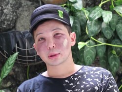 Pipi Pria Ini Bernanah dan Membusuk Pascasuntik Filler Oleh Dokter Palsu