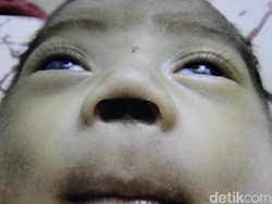 Sekat Hidung Bayi di Pekalongan Hilang, Diduga Korban Malpraktik