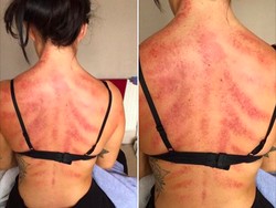 Bule Ini Viral karena Terapi Tradisional, yang Ternyata adalah Kerokan